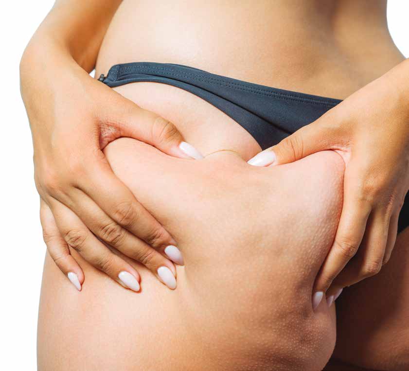 Cellulite: What's New?