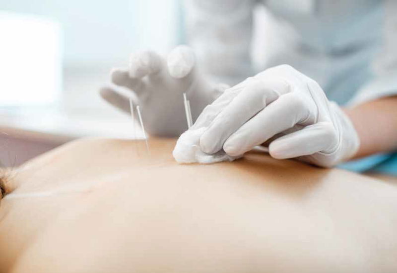 Ease Your Pain With Dry Needling