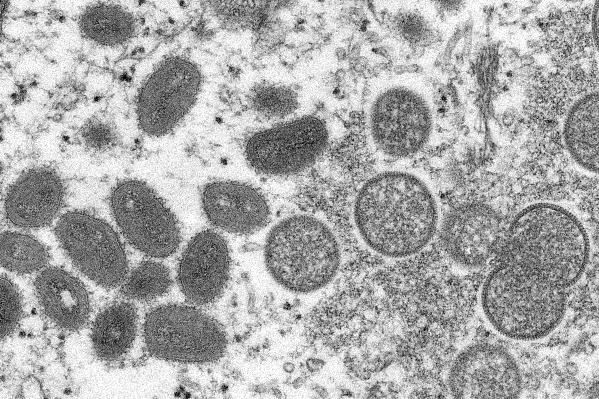 First Monkeypox case reported in Los Angeles County